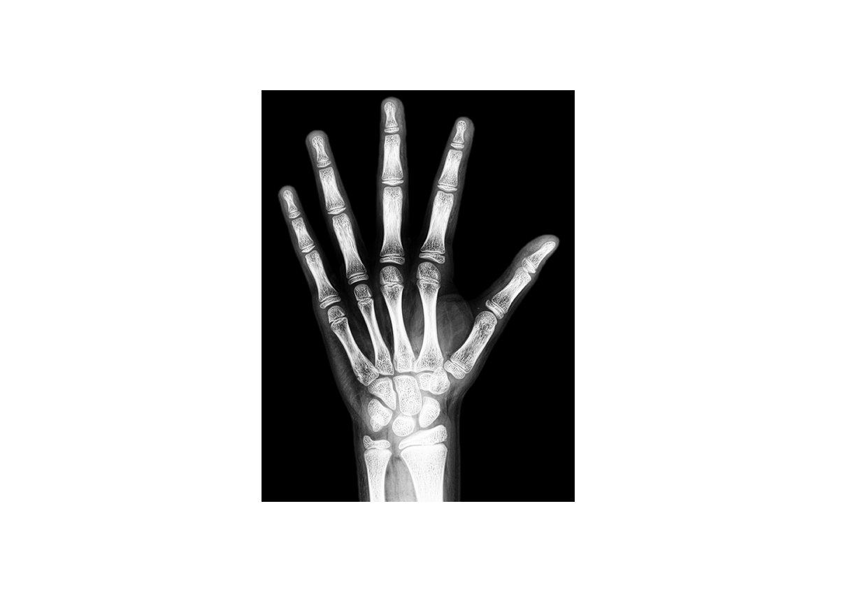 X IŞINI - Röntgen Işınları